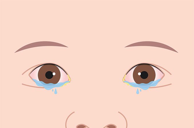 How to stop watery eyes