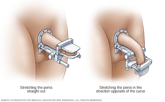 Get Rid of Curvature at Home