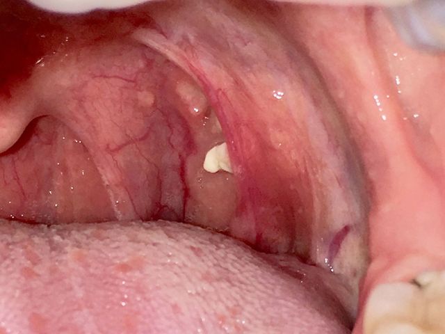 How to Properly Identify Tonsil Stones: 5 Effective Signs to Look For