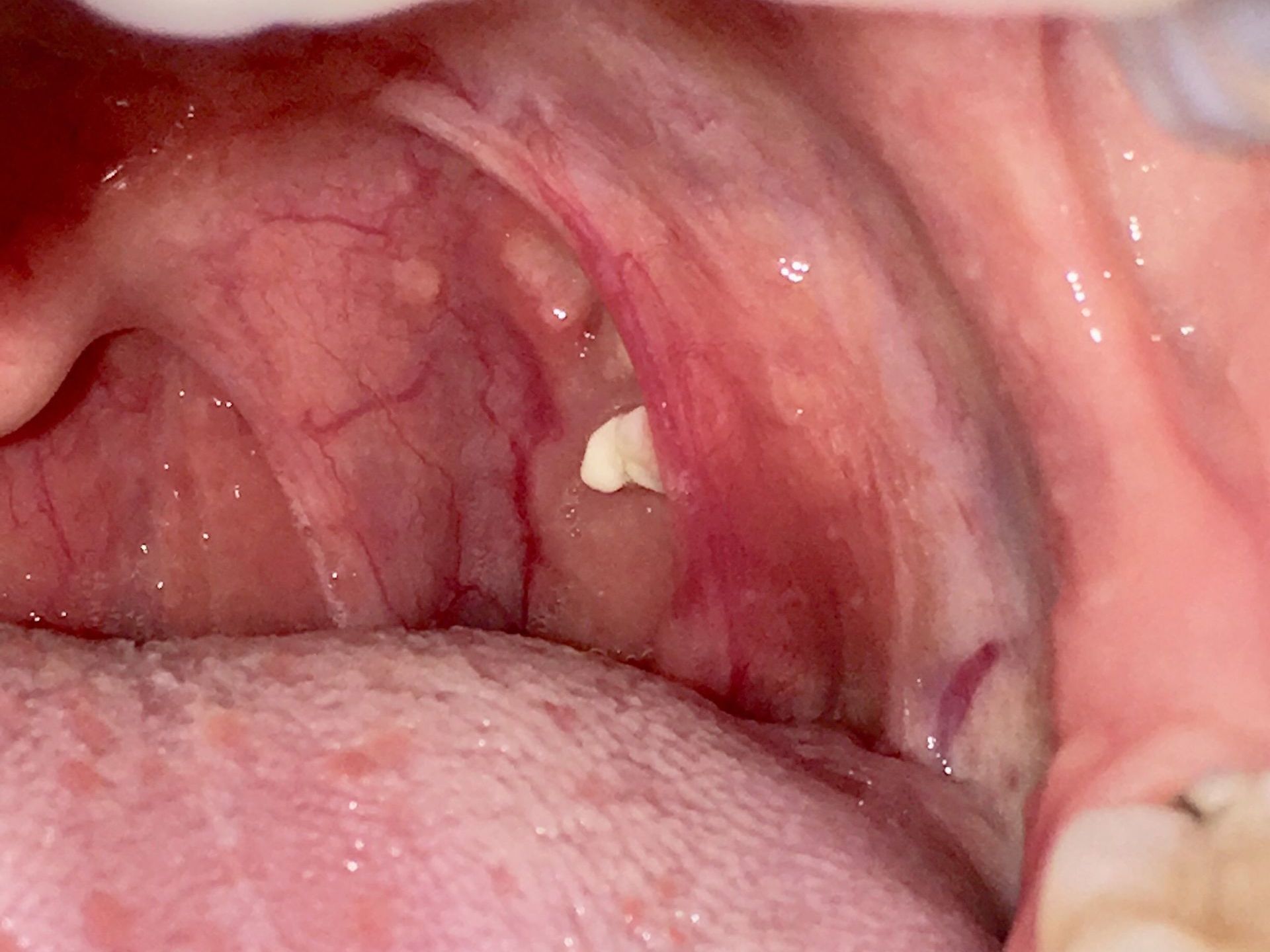 Effective Ways to Remove Tonsil Stones at Home in 2025: Essential Remedies Explained