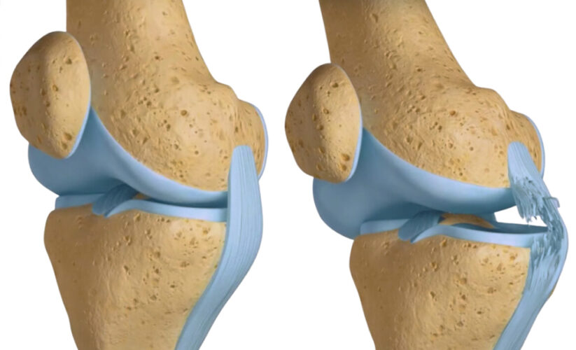 Top 5 Effective Ways to Heal a Sprained Knee in 2025 – Discover Quick Recovery Tips