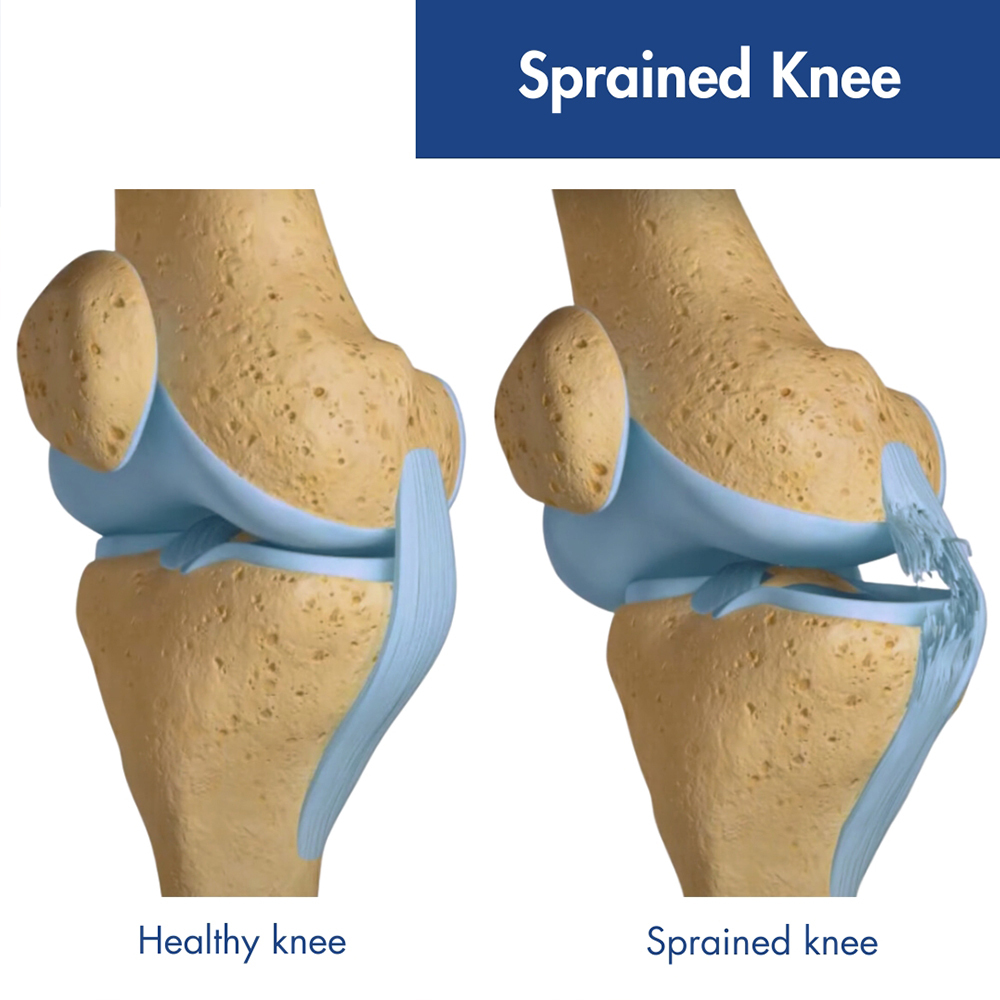 Top 5 Effective Ways to Heal a Sprained Knee in 2025 – Discover Quick Recovery Tips