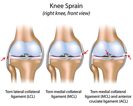 How to heal a sprained knee quickly