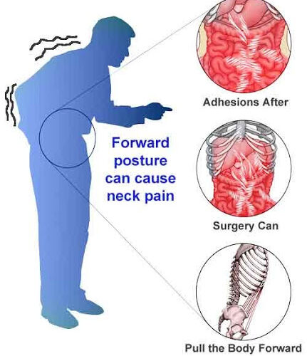 Effective Ways to Dissolve Adhesions Without Surgery in 2025 – Discover Proven Techniques for Relief