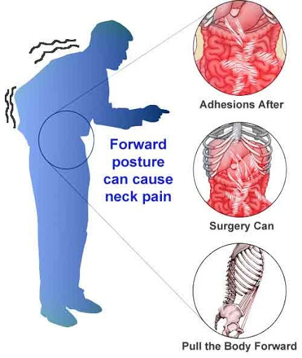 Effective Ways to Dissolve Adhesions Without Surgery in 2025 – Discover Proven Techniques for Relief